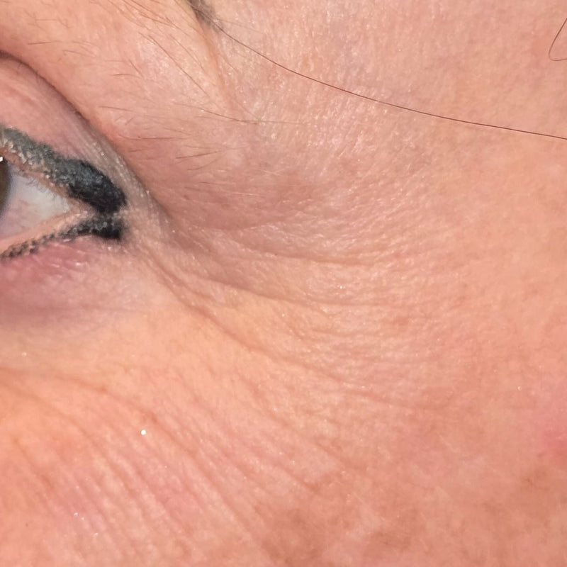 EYE – Vorher